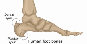 Heel Spurs - The Foot Care Group