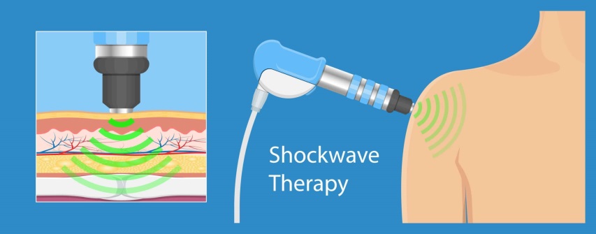 Shockwave Therapy - 6 Clinics across the Lower Mainland - Back in Motion  Health