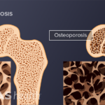 What You Need to Know About Osteoporosis | Spine-health