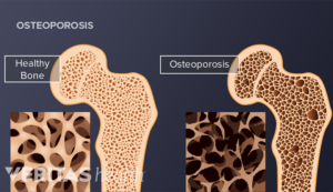 What You Need to Know About Osteoporosis | Spine-health