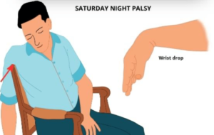 Saturday Night Palsy: A Case Discussion – International ...