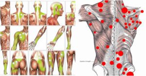 Myofascial trigger points definition, signs, symptoms, diagnosis & therapy